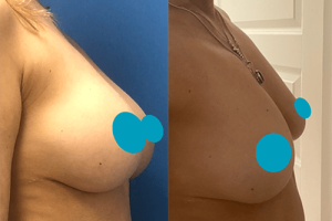 Krūtų implantų pašalinimas