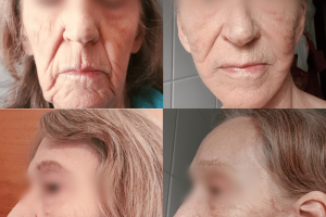 Riebalų persodinimas + Klasikinis veido patempimas + Antakių pakėlimas