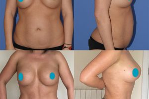 Krūtų implantų keitimas + Pilvo plastika + Riebalų nusiurbimas