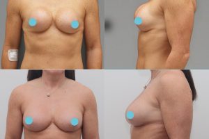 Krūtų implantų keitimas