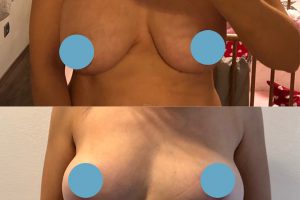 Krūtų implantų keitimas + Krūtų pakėlmas
