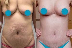 Pilvo plastika + Krūtų pakėlimas + Krūtų didinimas su implantais