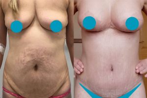 Pilvo plastika + Krūtų pakėlimas + Krūtų didinimas implantais