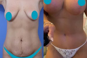 Krūtų didinimas su implantais + Krūtų pakėlimas + Pilvo plastika