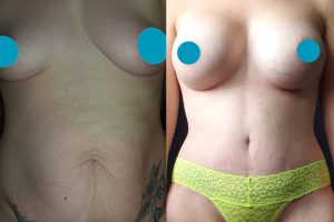Krūtų didinimas su implantais + Pilvo plastika