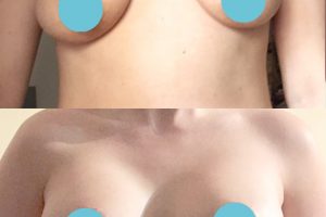 Krūtų didinimas su implantais + Krūtų pakėlimas