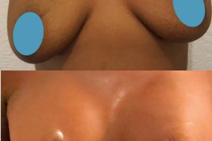 Krūtų didinimas implantais + Krūtų pakėlimas