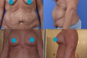 Fleur de Lis pilvo plastika + Krūtų pakėlimas + Krūtų didinimas su implantais