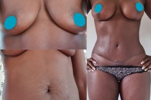 Krūtų pakėlimas su implantais + Pilvo plastika + Liemens liposukcija