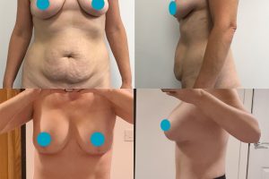 Pilvo plastika + Krūtų pakėlimas + Krūtų didinimas su implantais + Riebalų nusiurbimas