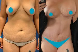 Pilvo plastika + Krūtų pakėlimas + Krūtų didinimas su implantais + Liemens liposukcija