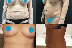 Pilvo plastika + Šonų liposukcija + Krūtų implantų išėmimas + Krūtų pakėlimas