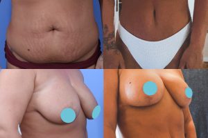 Pilvo plastika + Krūtų pakėlimas su implantais + Riebalų nusiurbimas