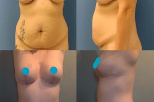 Pilvo plastika + Krūtų pakėlimas su implantais