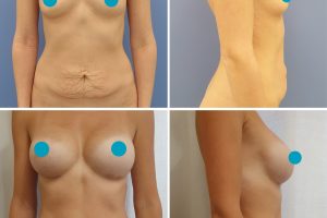 Pilvo plastika + Krūtų didinimas