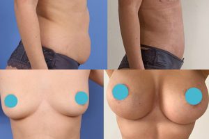 Pilvo plastika + Riebalų nusiurbimas + Krūtų didinimas implantais