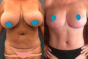 Pilvo plastika + Liemens liposukcija + Krūtų mažinimas